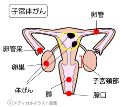 子宮体がん人体図 メディカルイラスト図鑑 無料の医療 美容素材集