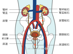 尿路結石症の結石部位一覧の人体図(男性)