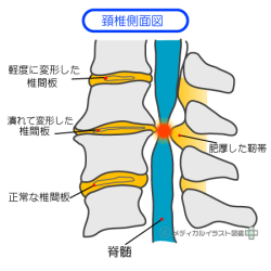 頚椎症性脊髄症の人体図
