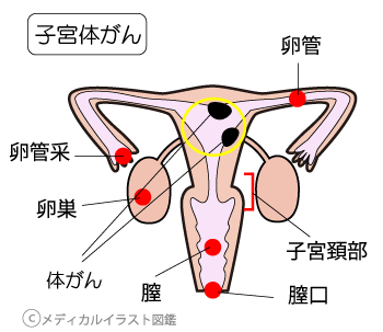 子宮体がん人体図 メディカルイラスト図鑑 無料の医療 美容素材集