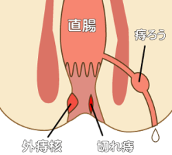 肛門図解 切れ痔 痔ろう いぼ痔 メディカルイラスト図鑑 無料の医療 美容素材集