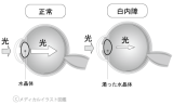 白内障の症状 濁った水晶体 メディカルイラスト図鑑 無料の医療 美容素材集