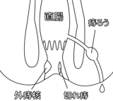 肛門図解 切れ痔 痔ろう いぼ痔 メディカルイラスト図鑑 無料の医療 美容素材集
