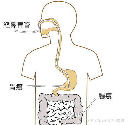 経管栄養方法の解説図解 メディカルイラスト図鑑 無料の医療 美容素材集