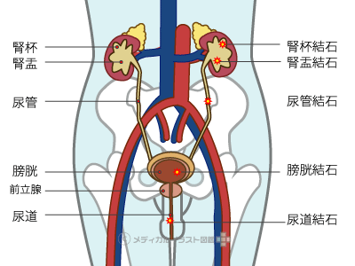 尿路結石症の結石部位一覧の人体図 男性 メディカルイラスト図鑑 無料の医療 美容素材集